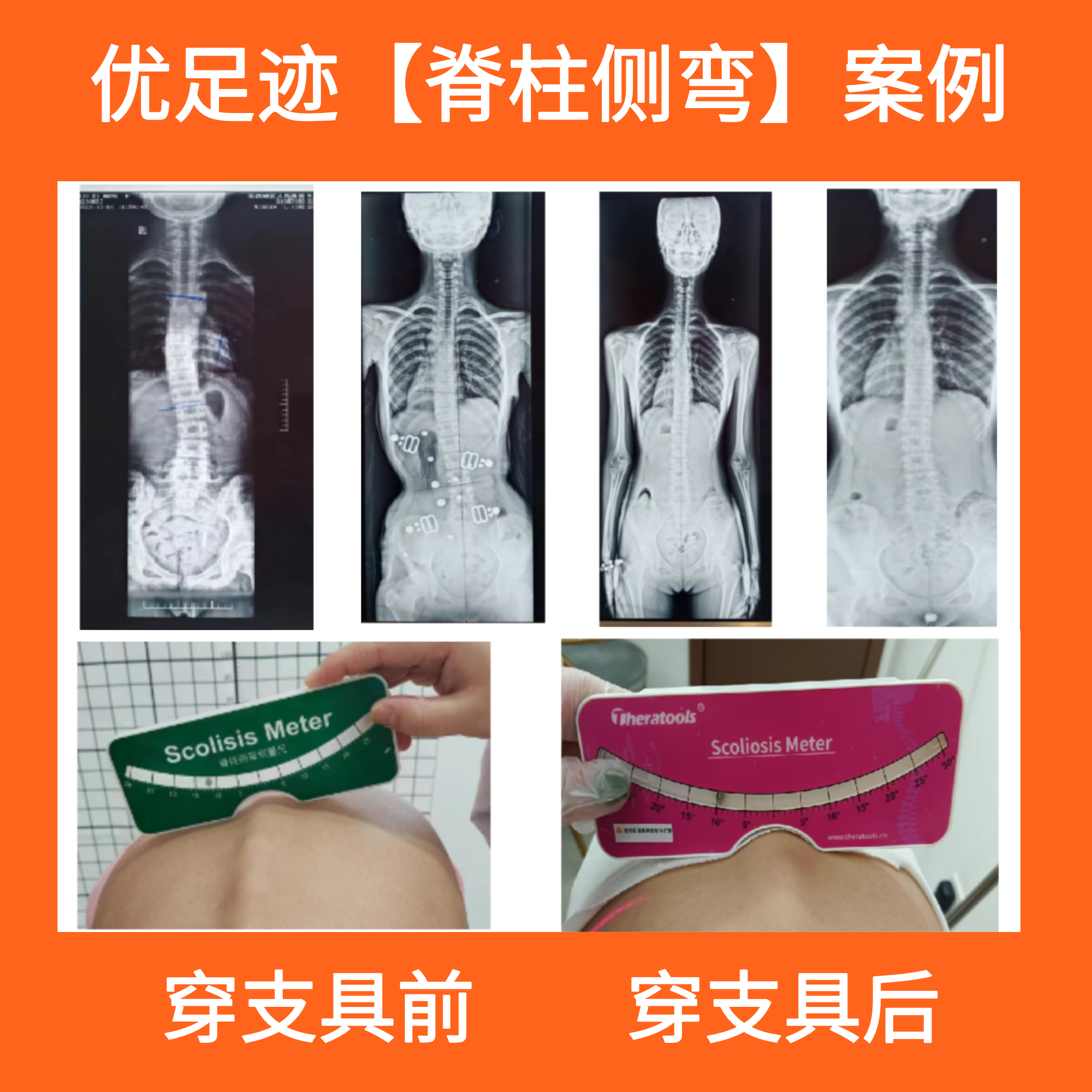 案例 | 一年时间脊柱侧弯几乎矫正