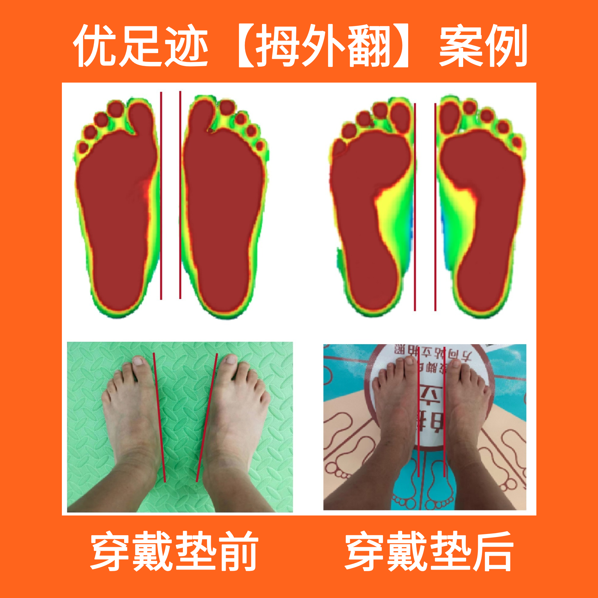 案例 | 拇外翻矫正