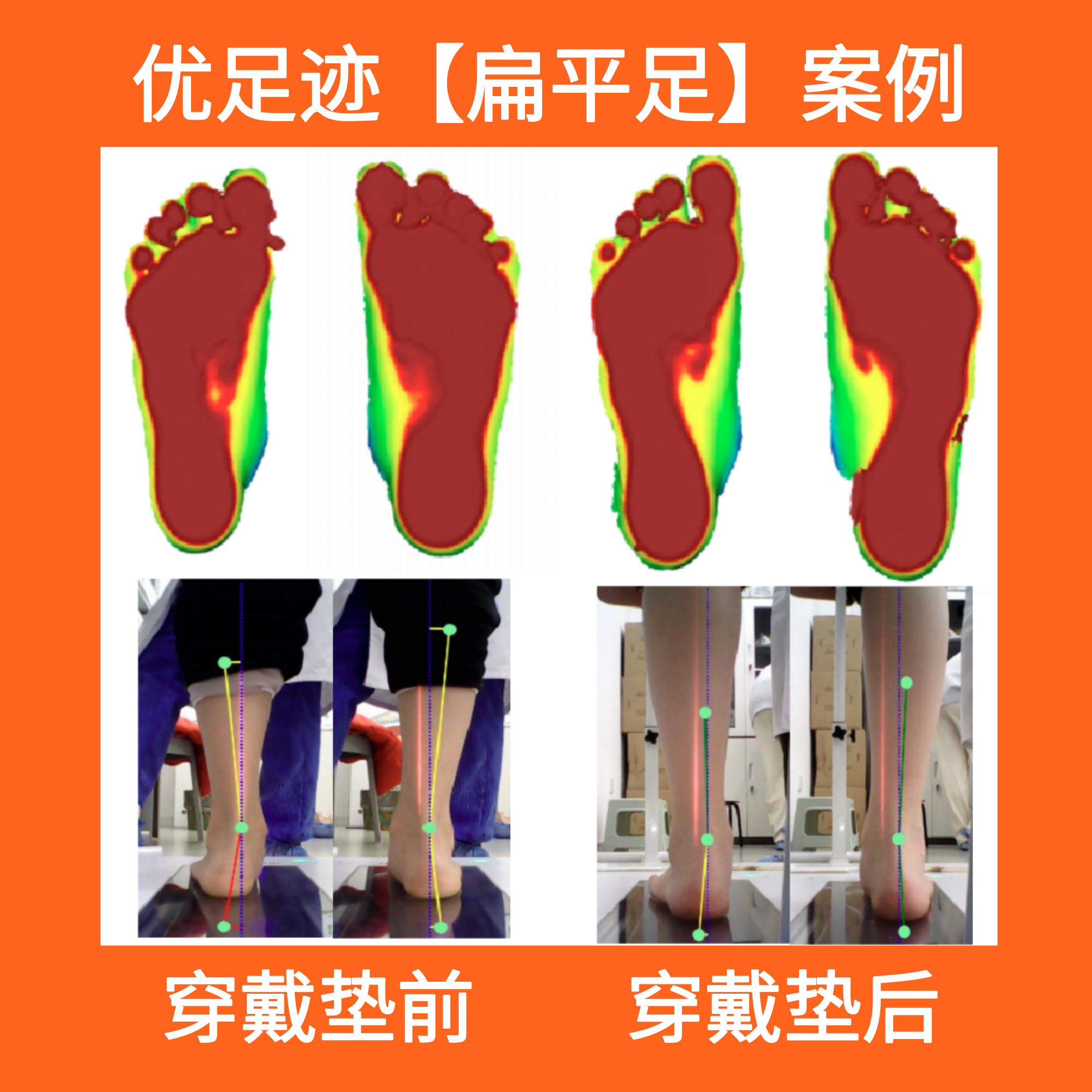 案例 | 扁平足矫正