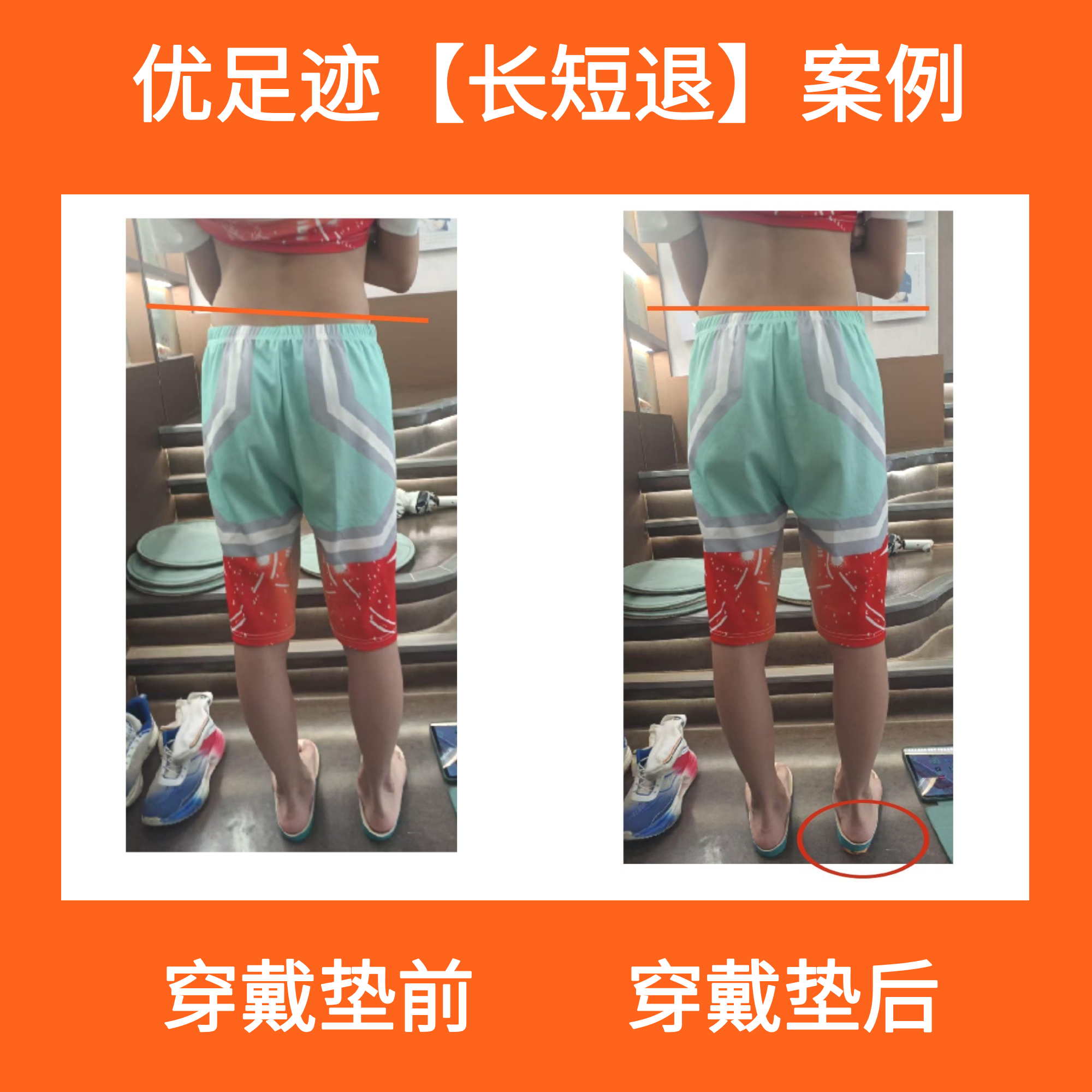 案例 | 长短腿案例