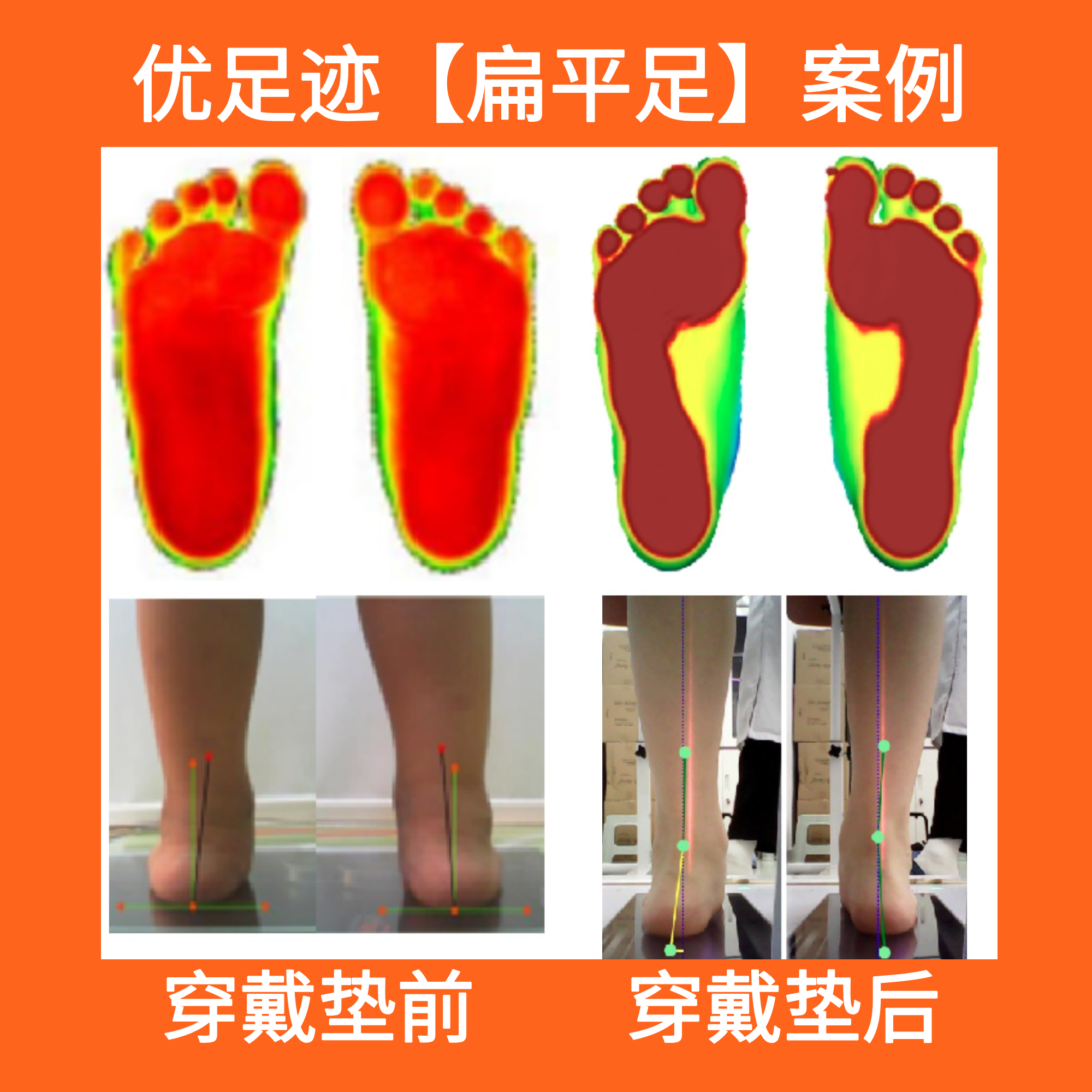 案例 | 扁平足矫正