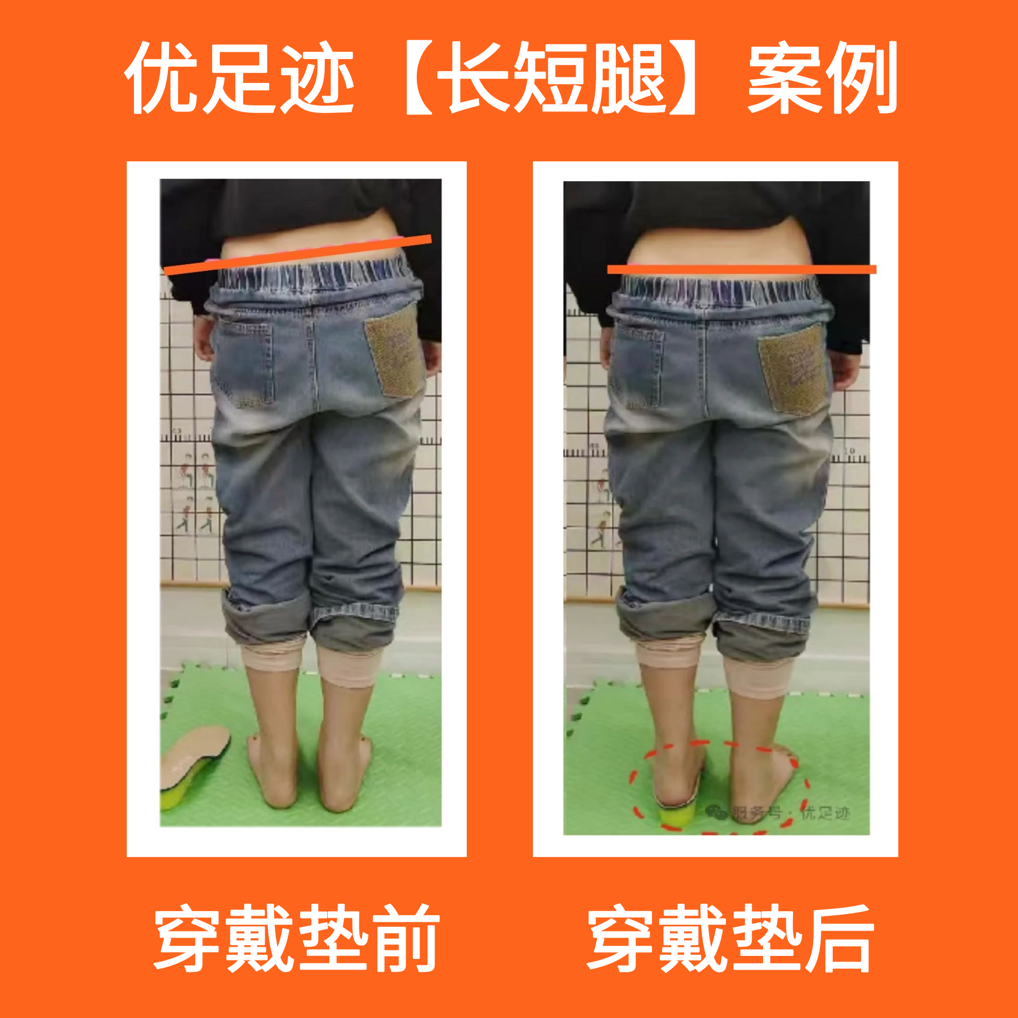 案例 | 儿童长短腿补高案例