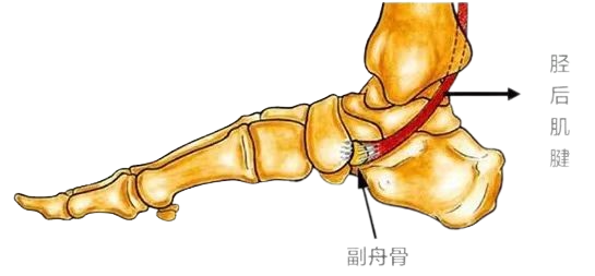 科普 | 脚上多长了一块骨头？家里娃是扁平足的要注意了！
