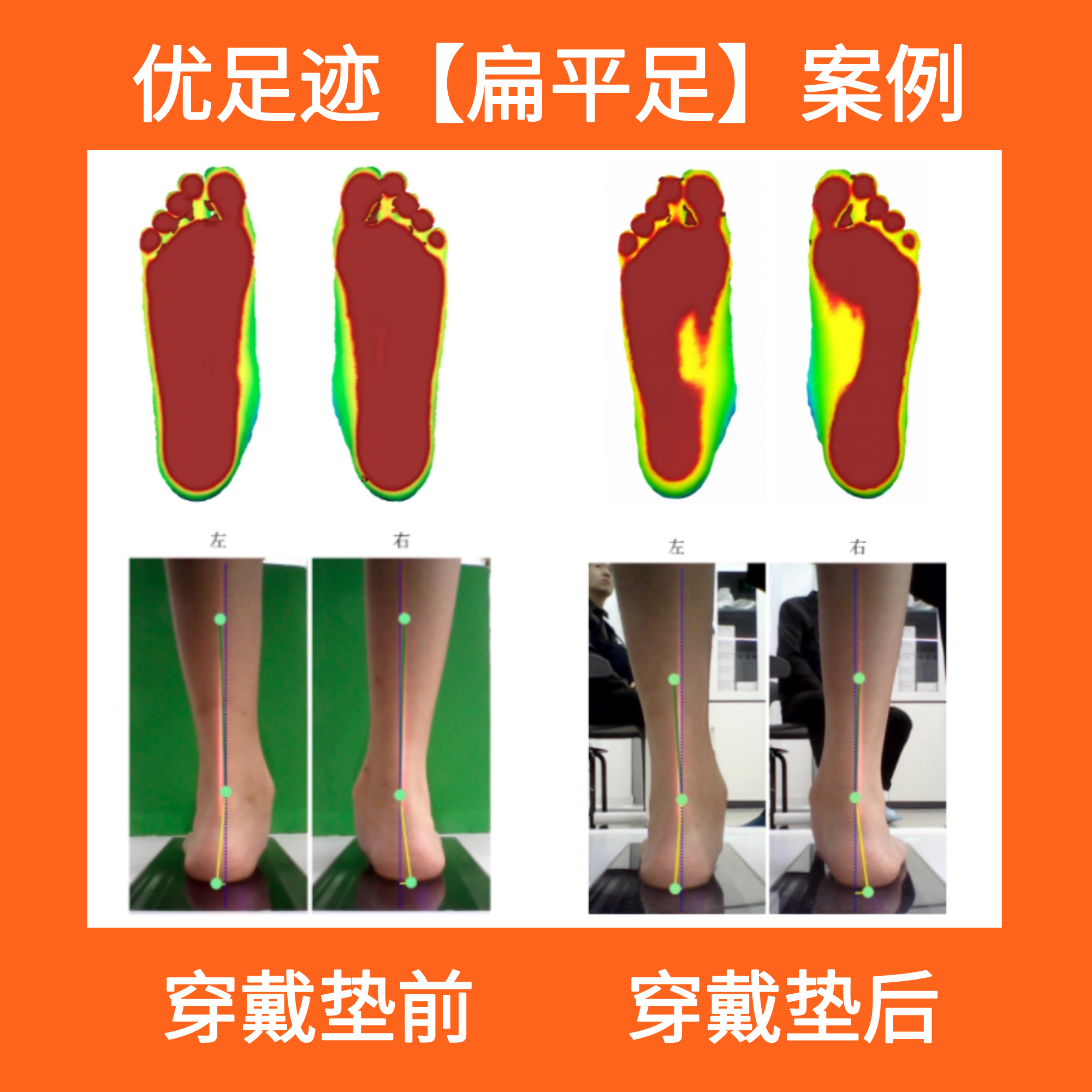 案例 | 儿童扁平足矫正