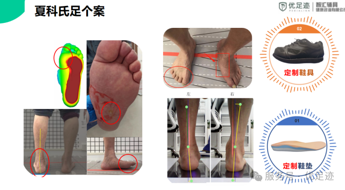 糖尿病足·评估健康服务中心丨糖尿病足的预防与辅具应用