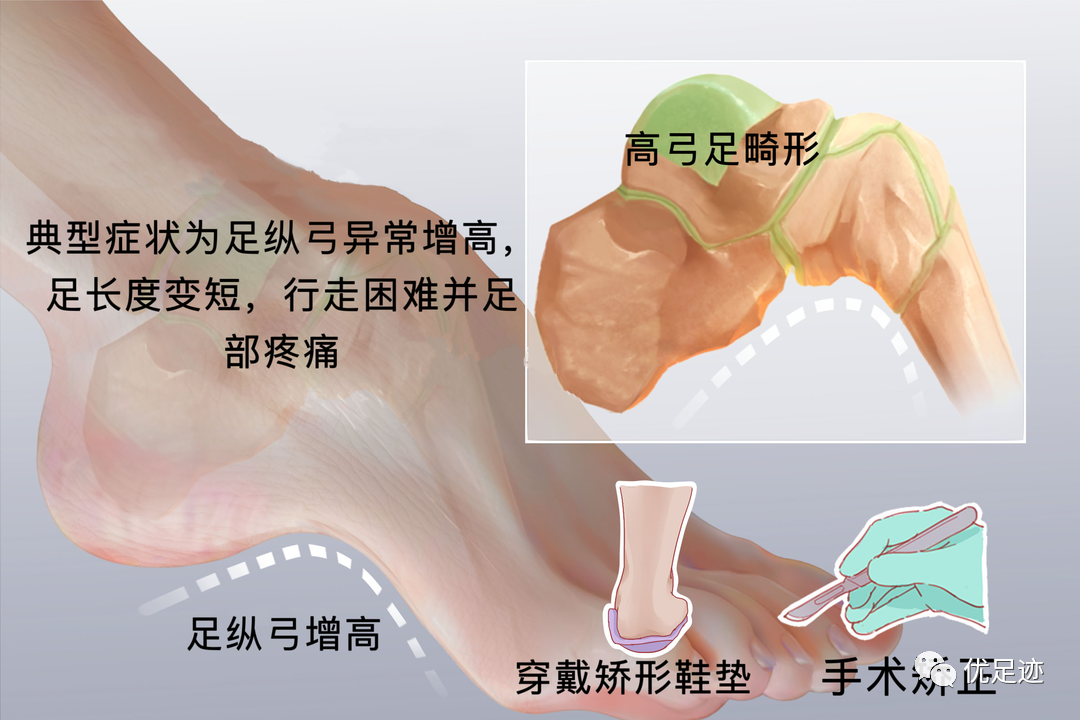 孩子脚痛别大意，或许是高弓足在作怪！