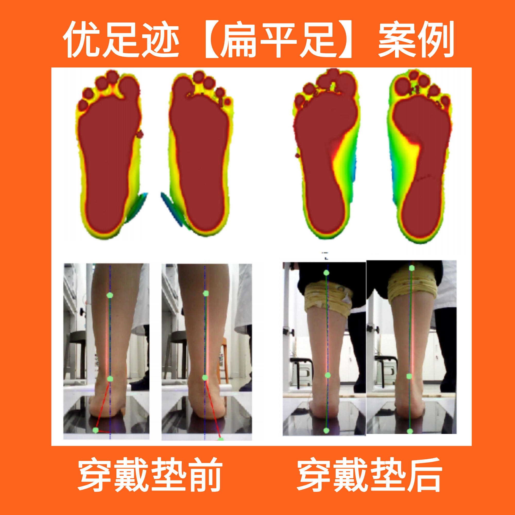 案例 | 扁平足矫正