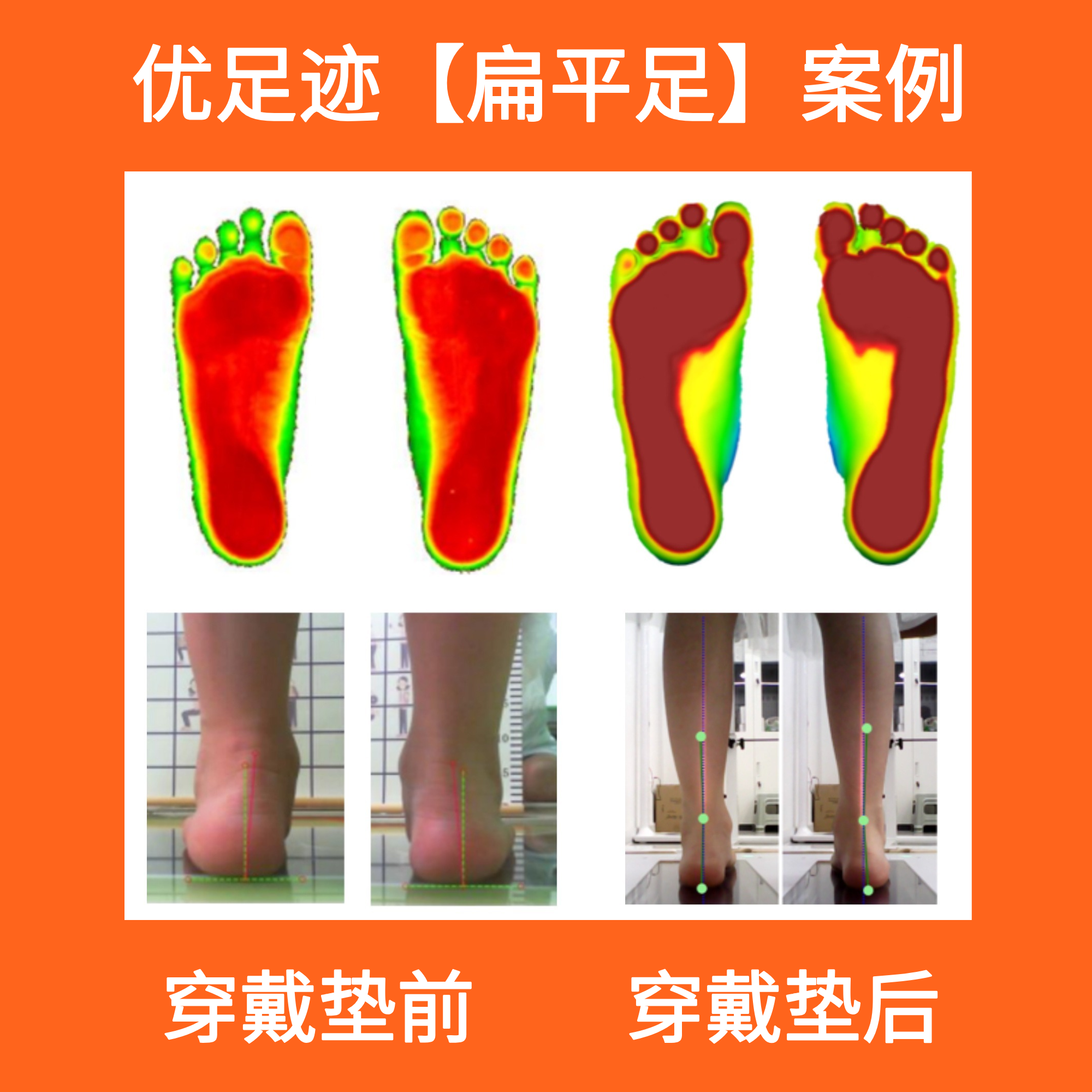 案例 | 扁平足矫正
