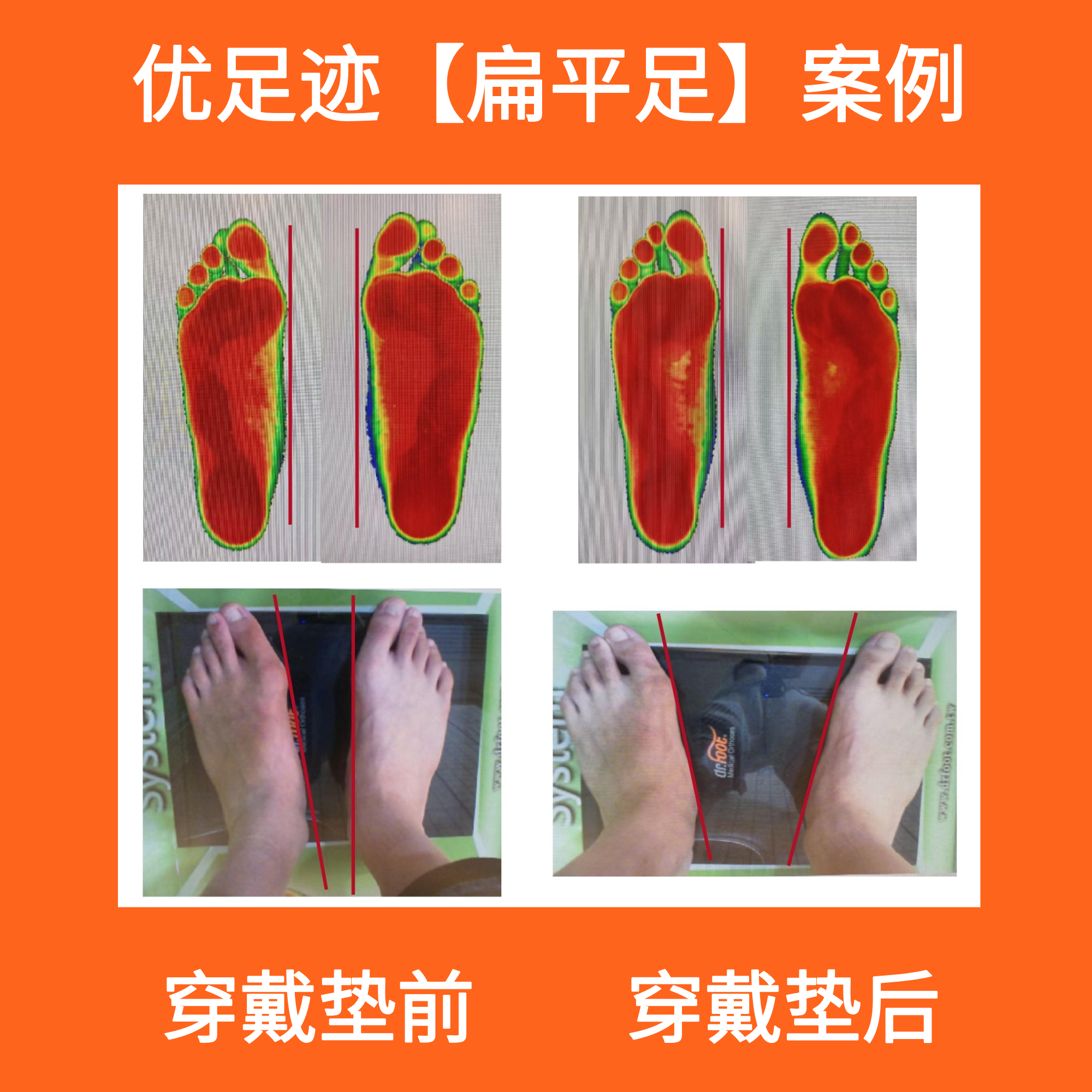 Case | Hallux Valgus Correction Case