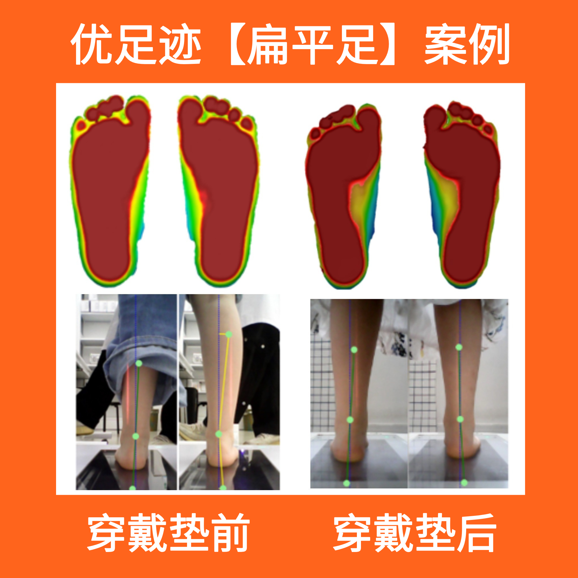 Case | Intoeing Gait Correction Case