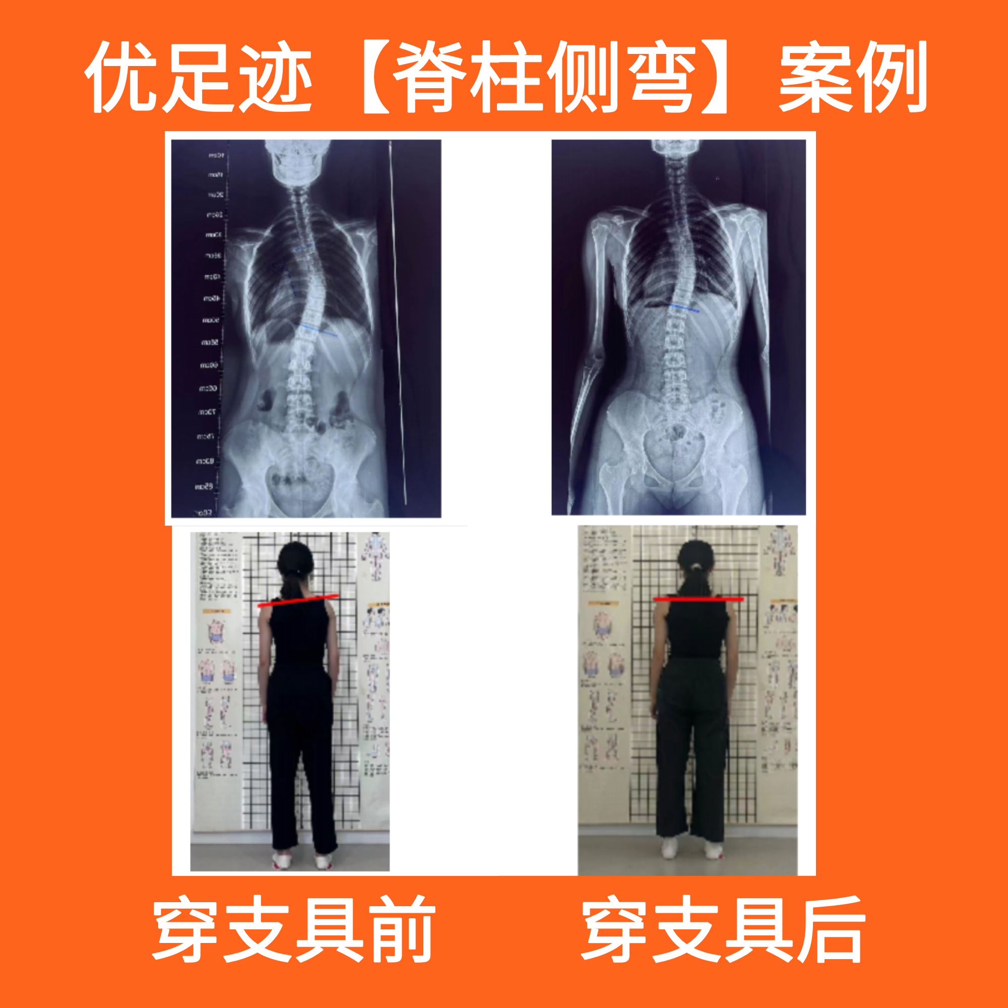 Case | 34° Scoliosis Correction