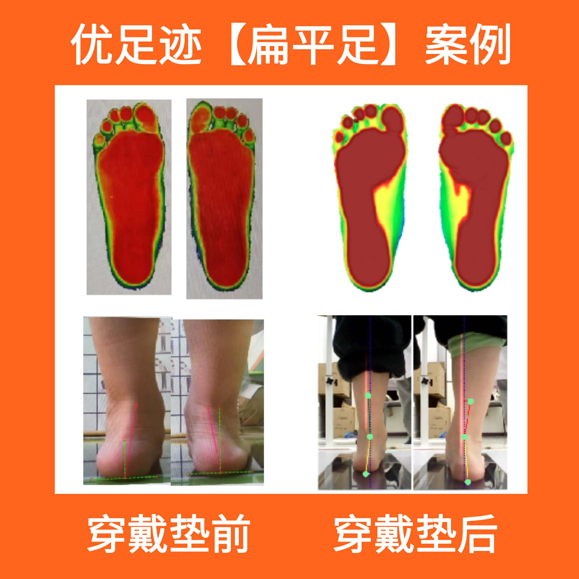 Case | Pediatric Flat Foot Correction Case