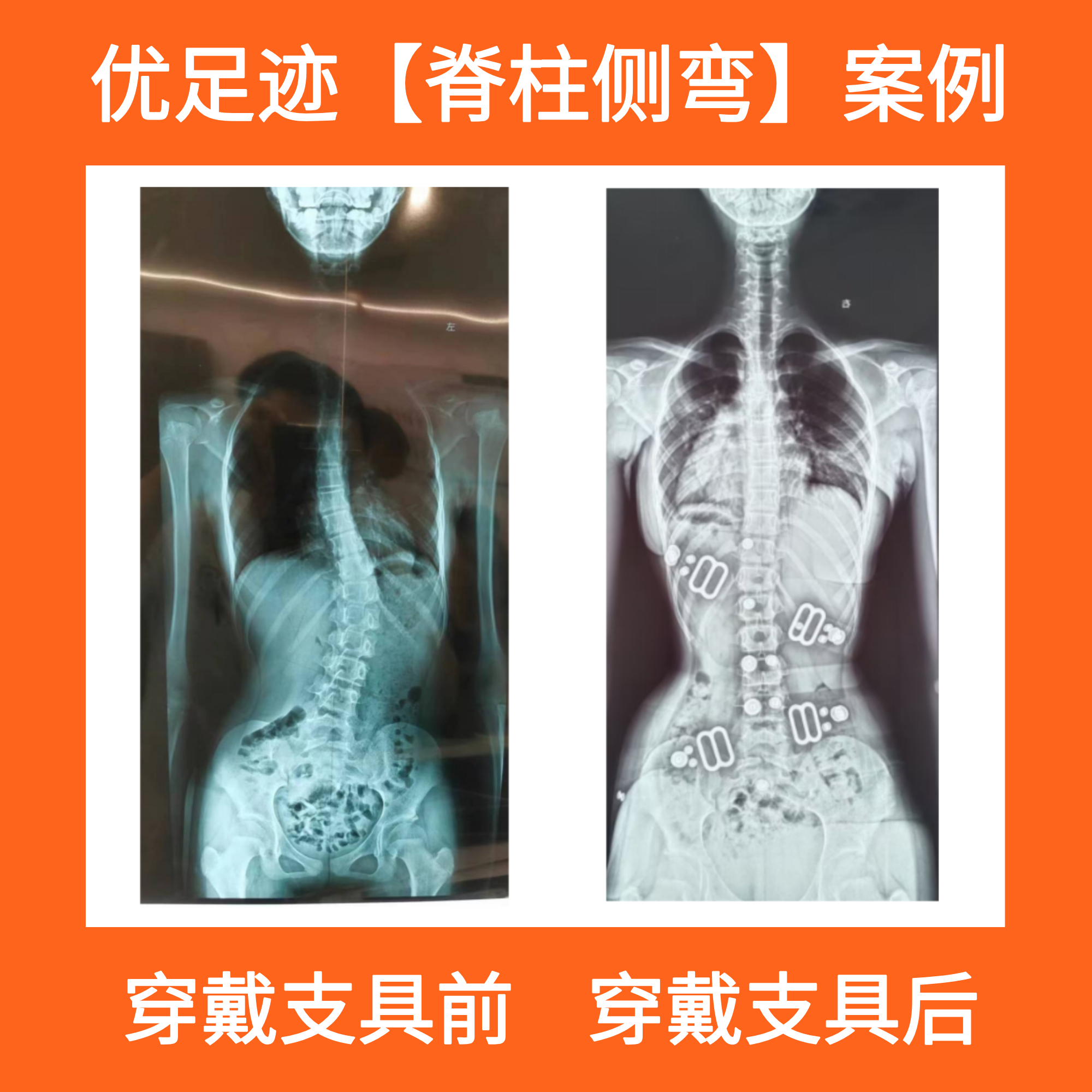 Case | Scoliosis Correction