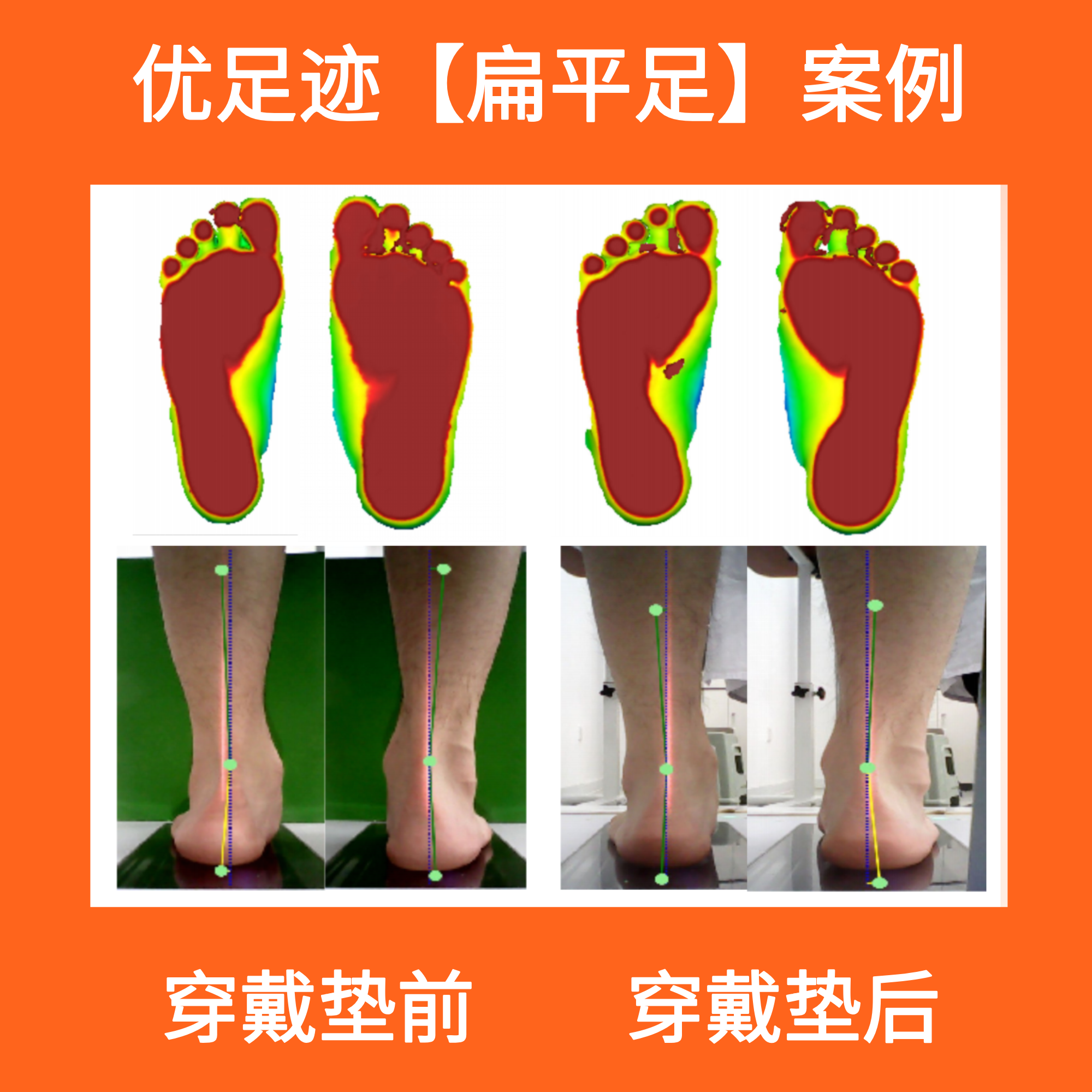 Case | Flat Foot Correction