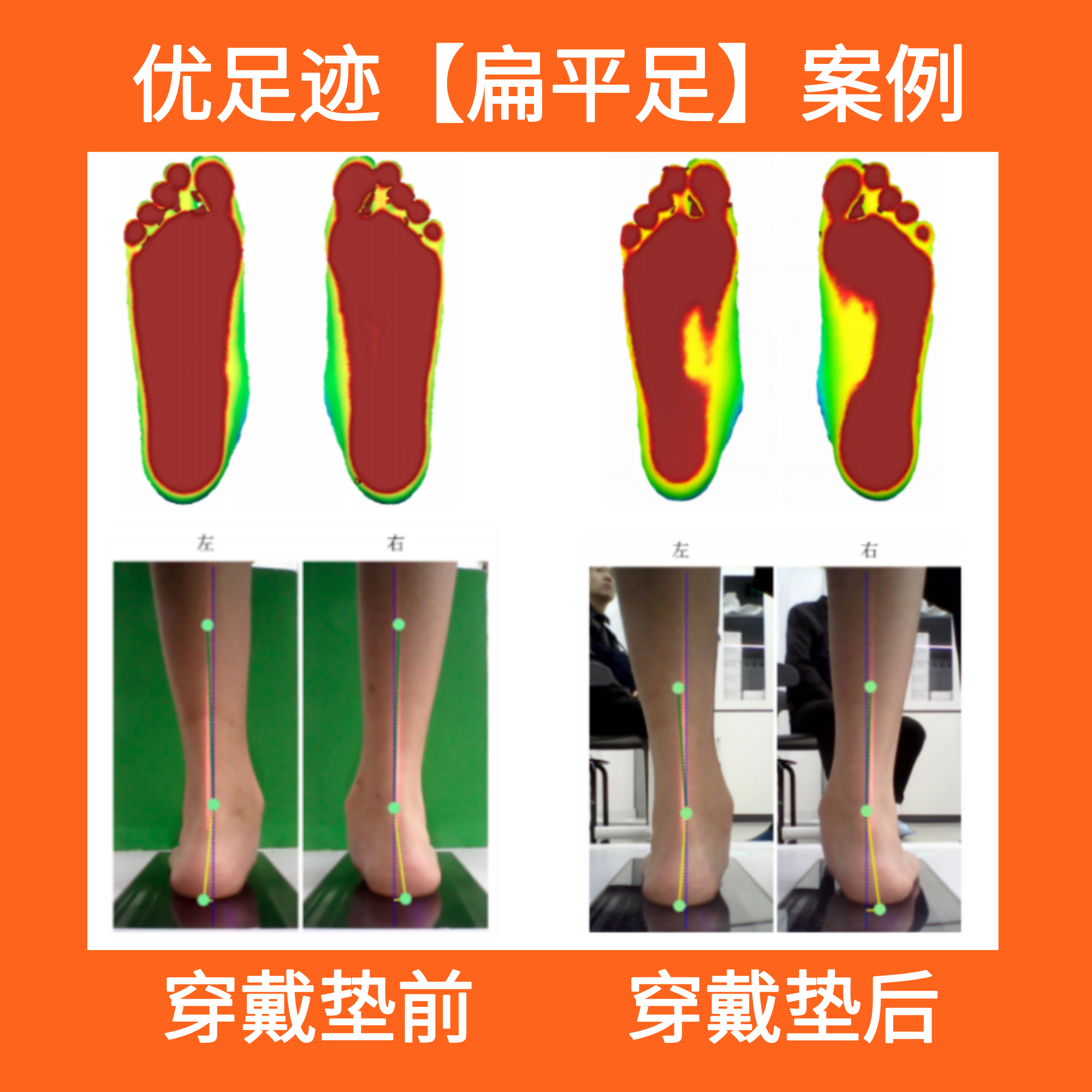Case | Flat Foot Correction