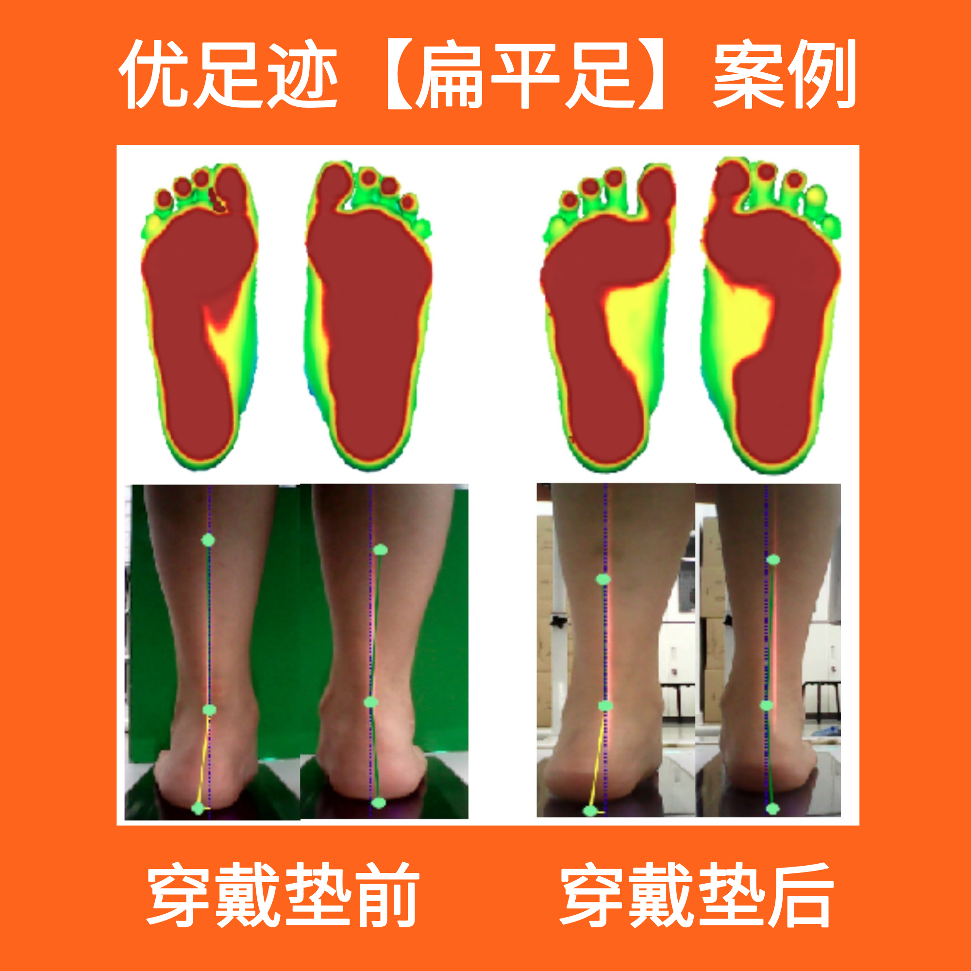 Case | Flat Foot with Accessory Navicular Pain