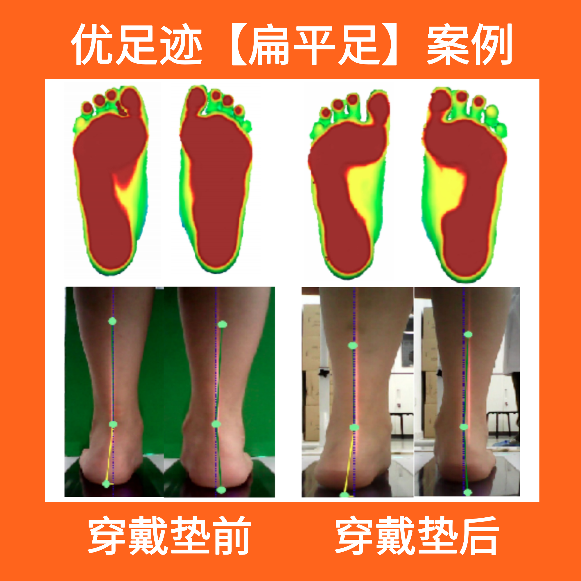 Case | Flat Foot Correction