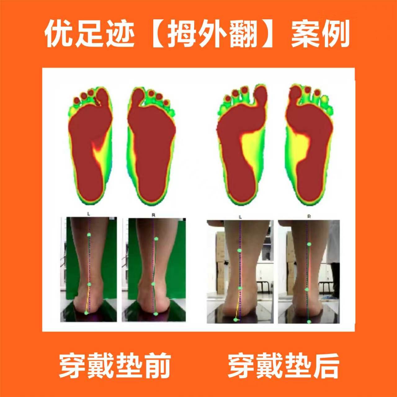 案例 | 拇指外翻矫正案例