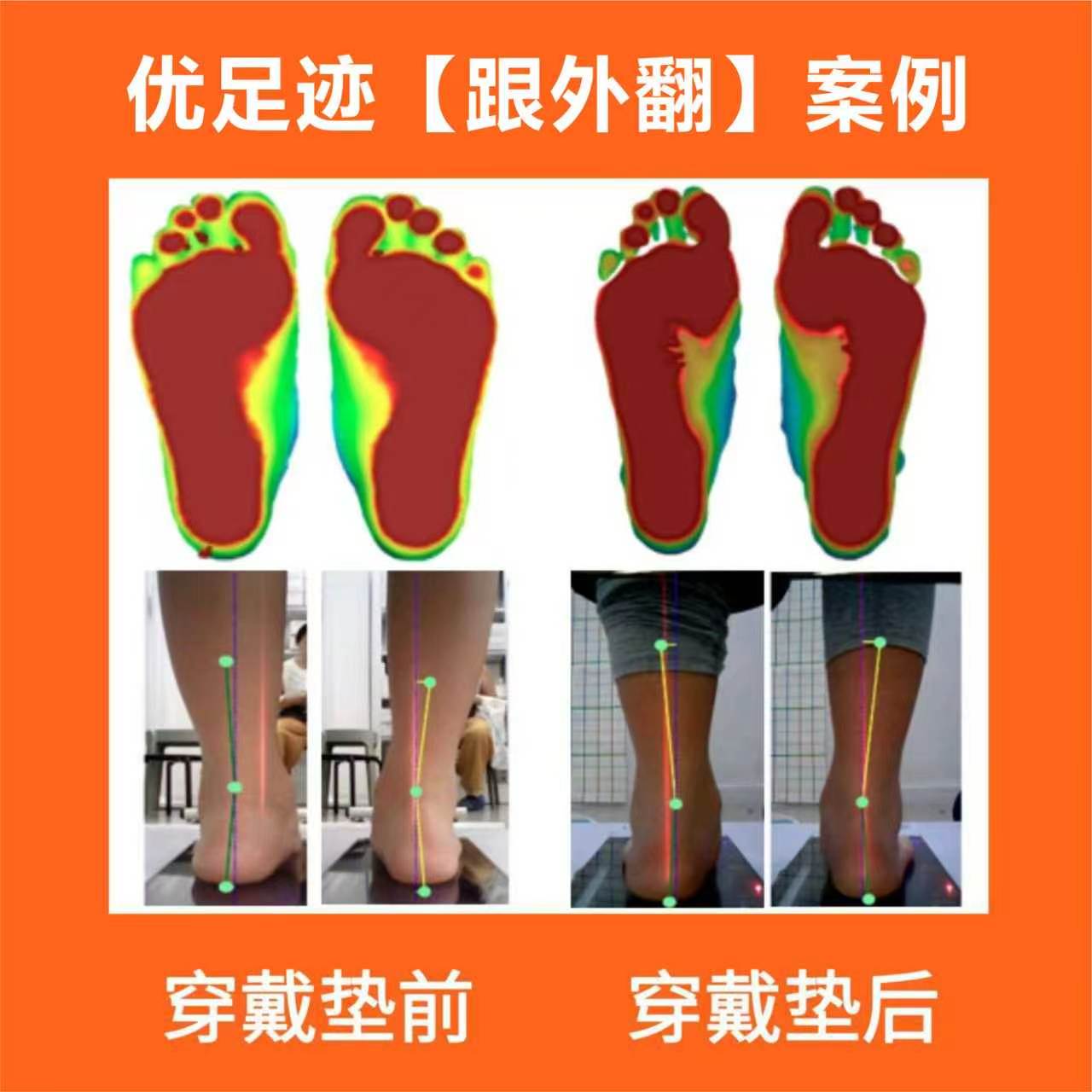 案例 | 跟外翻矫正案例