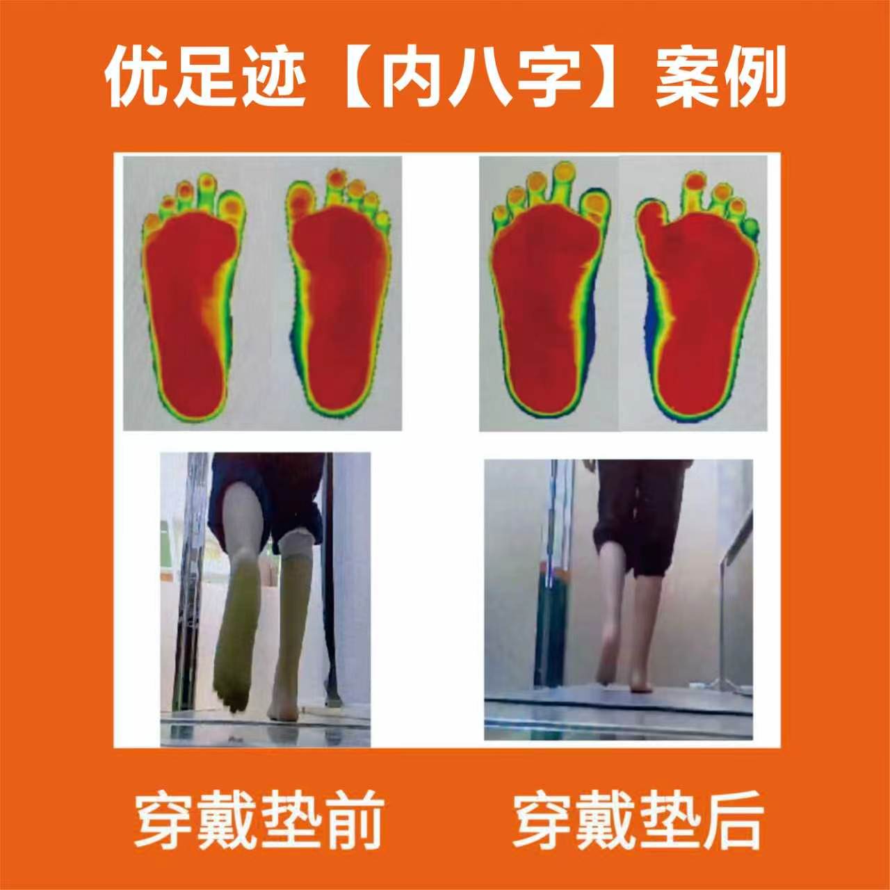 案例 | 内八字矫正案例