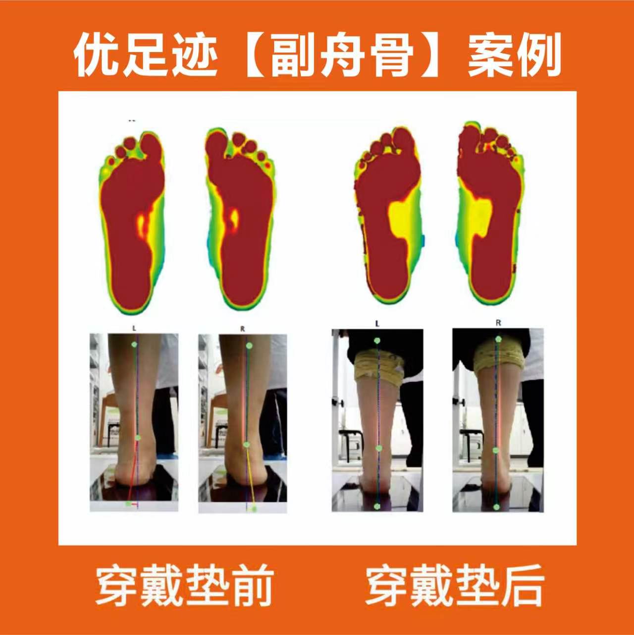 案例 | 扁平足副舟骨疼痛